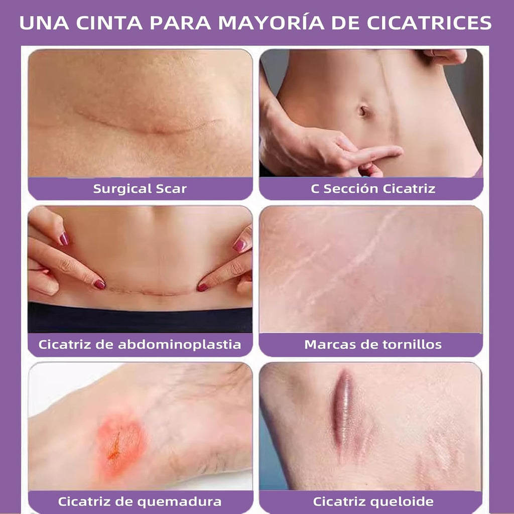 ✨ PARCHE DE SILICONA PARA CICATRICES